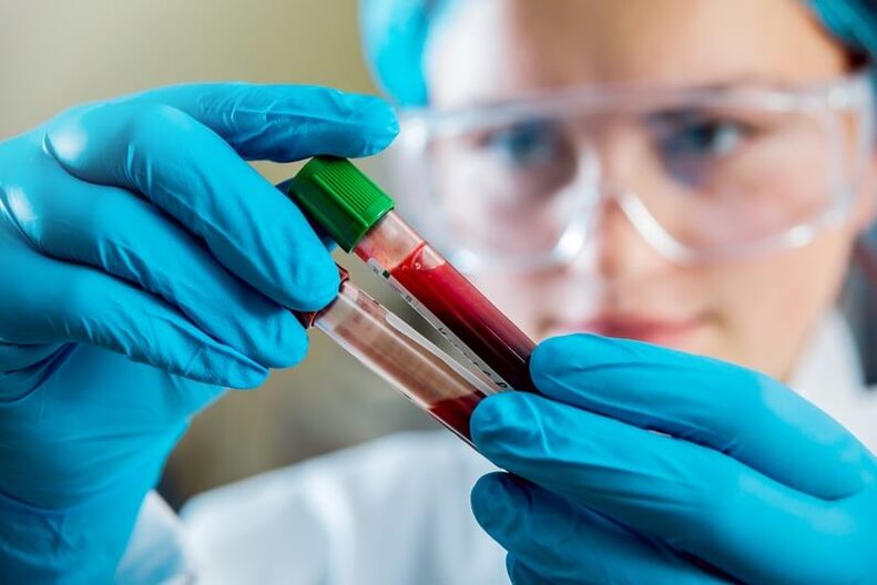 Potpuni test krvi za dijagnosticiranje boli u donjem dijelu leđa