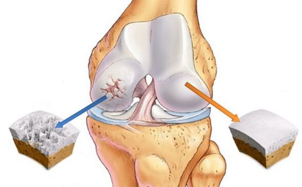 Osteoartritis zgloba koljena (lijevo) i normalne hrskavice (desno)