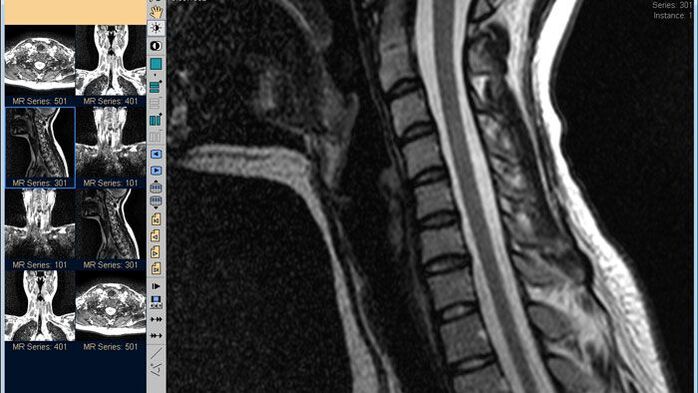 MRI vratne kralježnice najbolja je metoda za dijagnosticiranje bolova u vratu